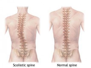 Treatment of Scoliosis